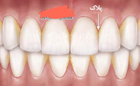 دستگاه جرمگیر دندان خانگی التراسونیک شارژی برند HANNEA