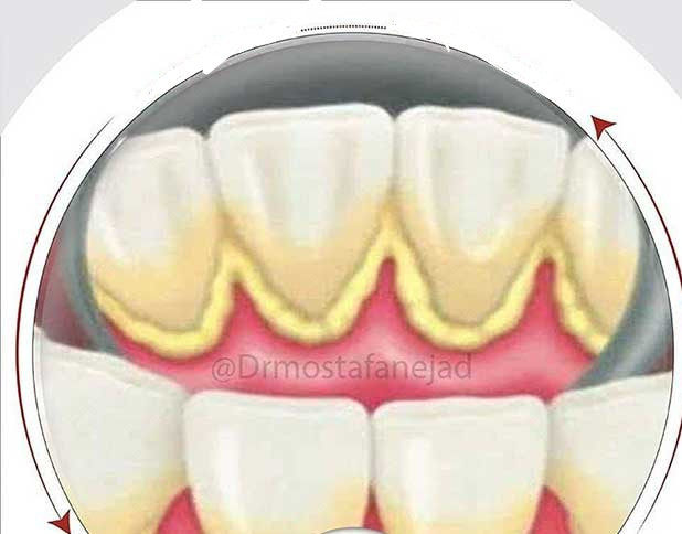 دستگاه جرمگیر دندان خانگی التراسونیک شارژی برند HANNEA