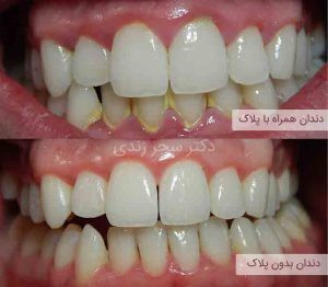 دستگاه جرمگیر دندان خانگی التراسونیک شارژی برند HANNEA